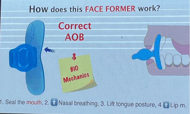 Khí cụ Face former giúp bệnh nhân hạn chế thở miệng